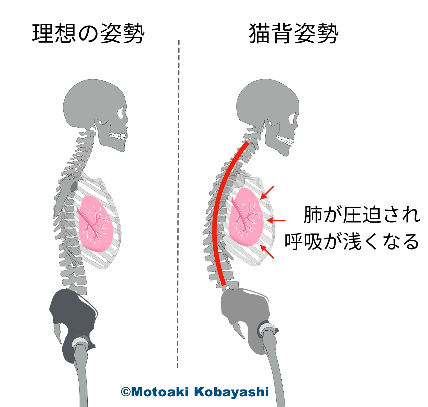 姿勢変化　胸椎後弯　呼吸がにしくい